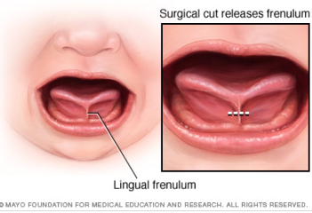 Image result for release tongue tie